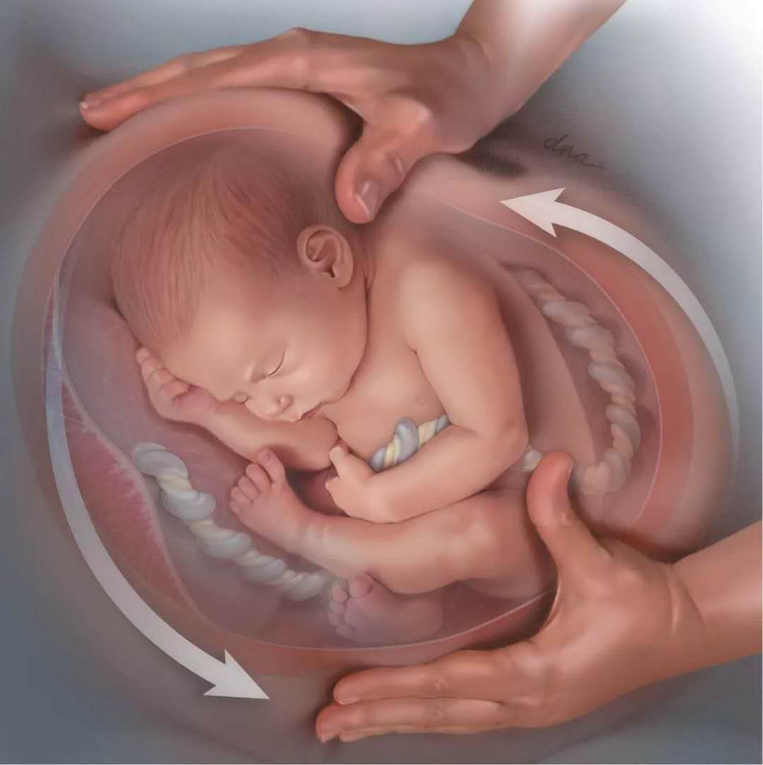 乾坤大挪移——神奇的胎儿臀位外倒转