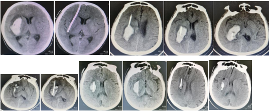 加强专科建设 提升神经危重病人救治能力