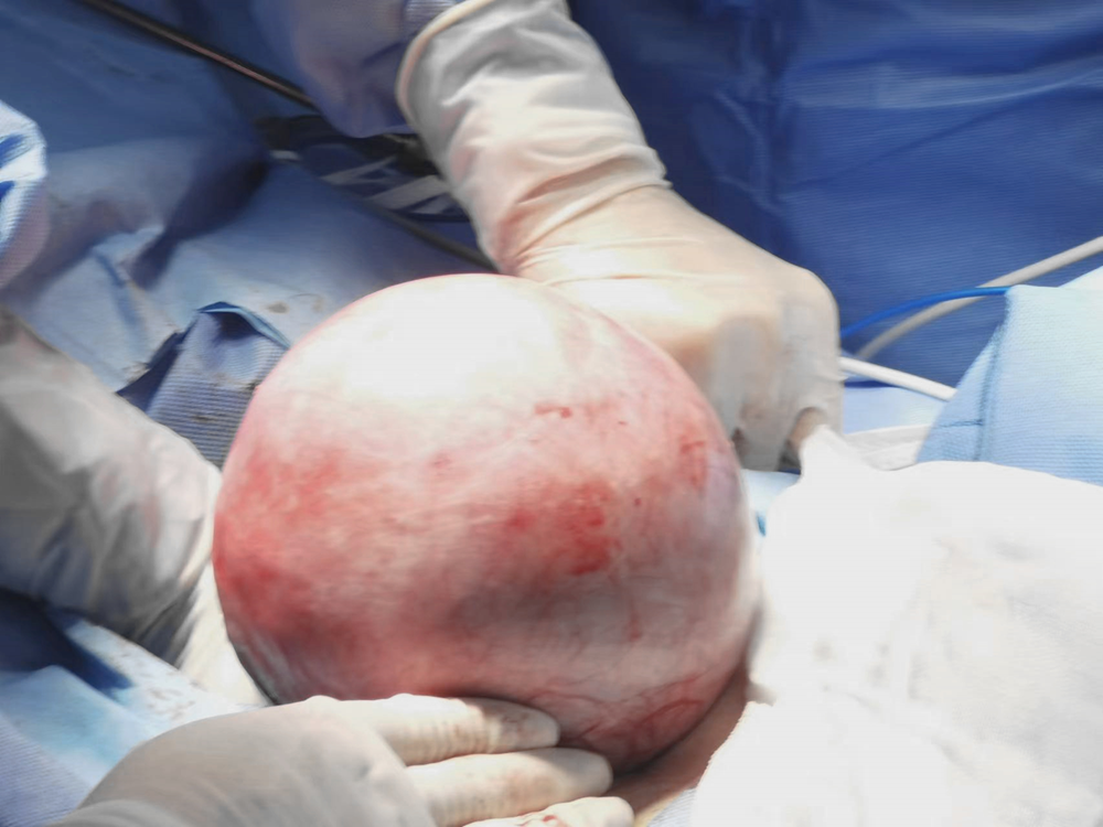 办实事 | 没想到 一次检查竟意外发现“胎儿头”大小罕见肿瘤